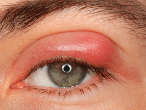 Aproximação de um chiqueiro de olho de homem calázio de doença oftálmica de  hordéolo