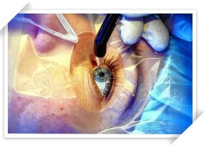 Cirurgia refrativa a laser | Dr. Marcelo Vilar
