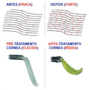 Córneas pós Crosslinking | Dr. Marcelo Vilar