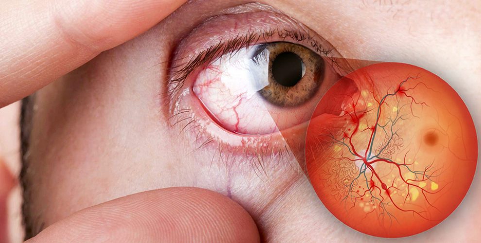 Doenças oculares diabetes | Dr. Marcelo Vilar