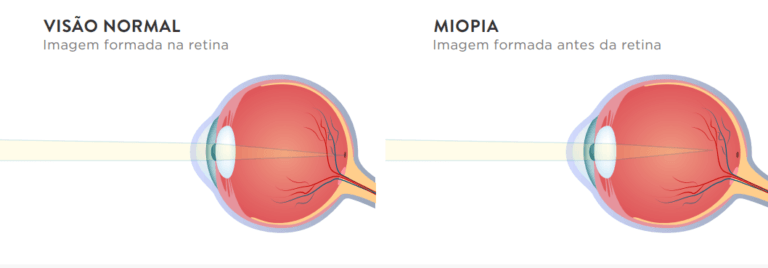 Miopia - Imagem 1 | Marcelo Vilar
