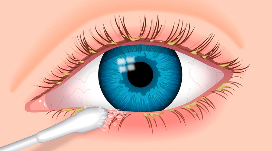 Tratamento de Blefarite ou Terçol em Curitiba
