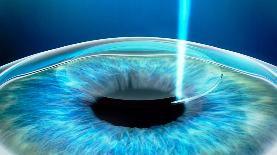 Laser - Transplante de Córnea | Dr. Marcelo Vilar