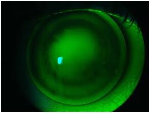 Ceratocone lentes de contato | Dr. Marcelo Vilar