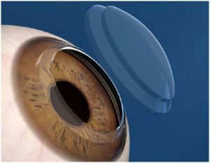 Transplante de Córnea a Laser | Dr. Marcelo Vilar