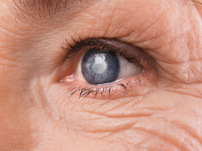 Cirurgia A Laser Para Clarear Os Olhos Sobre Os Olhos