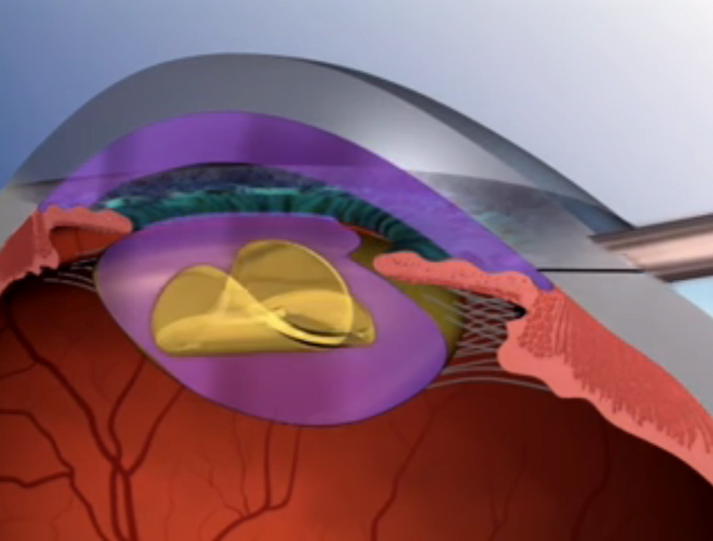 Como funciona a cirurgia de catarata - Imagem 2 | Marcelo Vilar